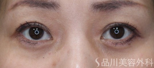 症例NO.69932のAFTER写真