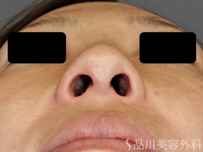 症例NO.72949のBEFORE写真