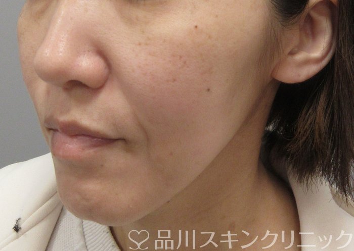 症例NO.69837のAFTER写真