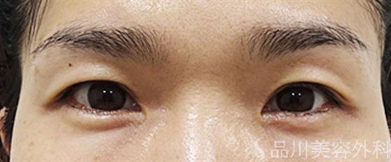症例NO.53744のBEFORE写真
