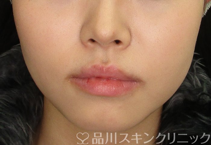 症例NO.70211のBEFORE写真