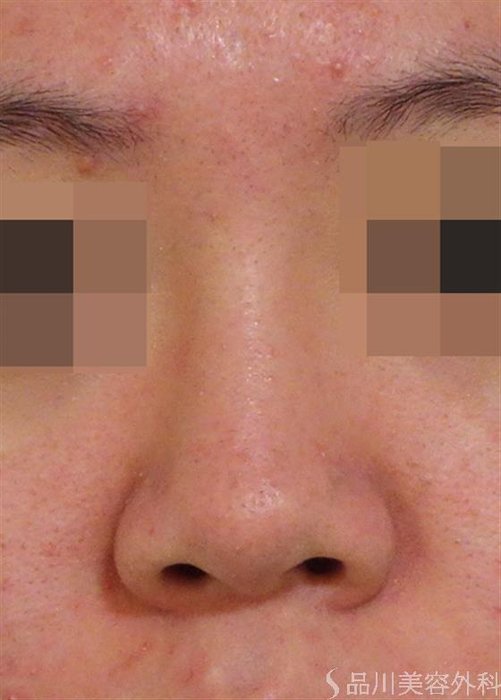 症例NO.40038のBEFORE写真