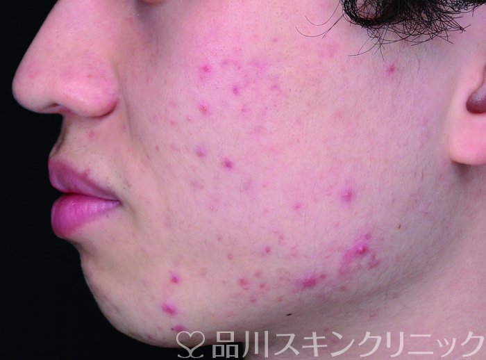 症例NO.72291のBEFORE写真