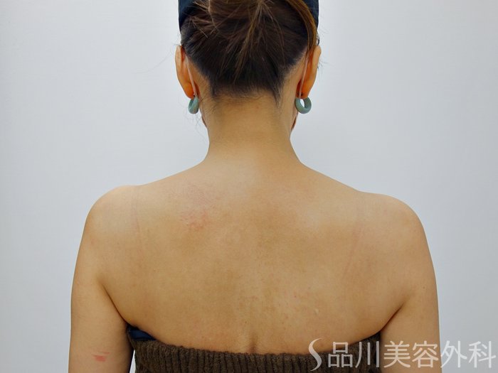 症例NO.73164のBEFORE写真