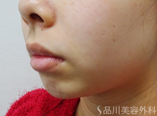 症例NO.73361のBEFORE写真