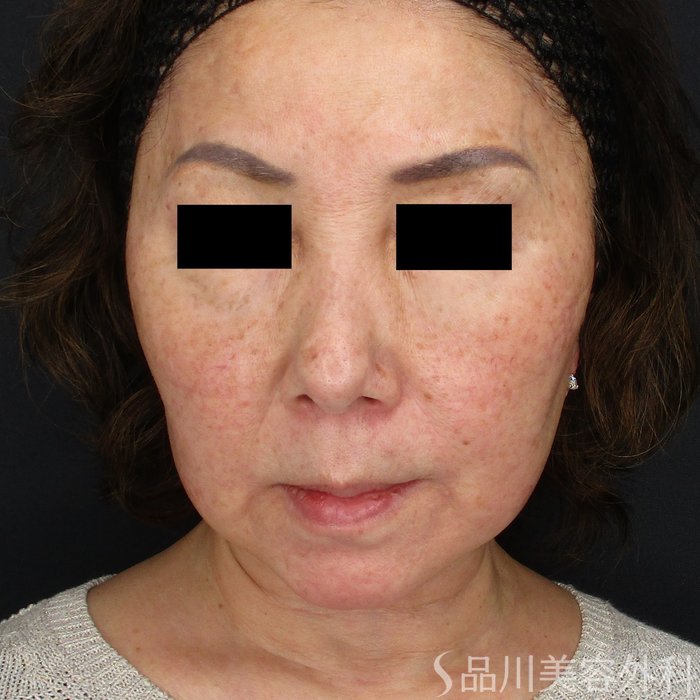 症例NO.64756のBEFORE写真