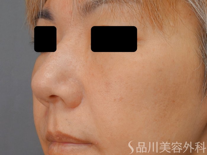 症例NO.74097のAFTER写真