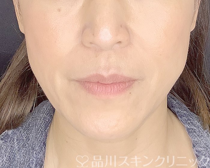 症例NO.67547のAFTER写真