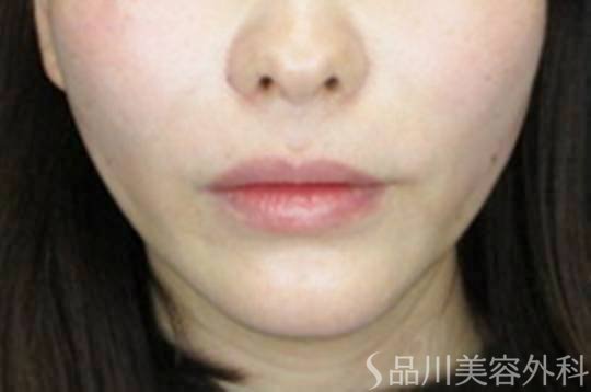 症例NO.73017のAFTER写真