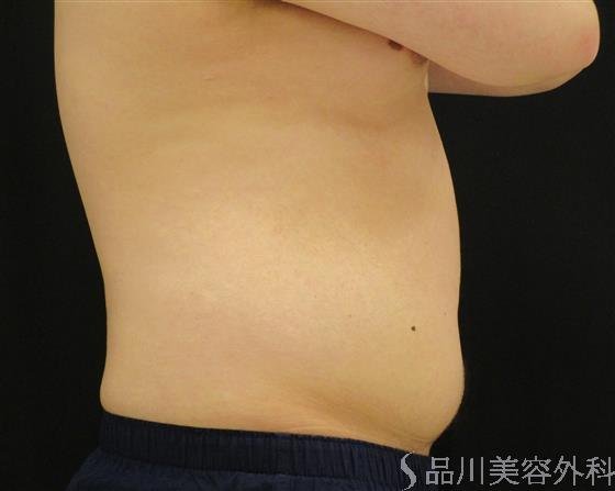 症例NO.51291のAFTER写真