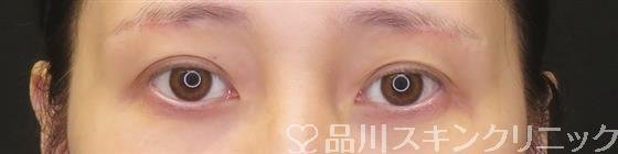 症例NO.61451のAFTER写真