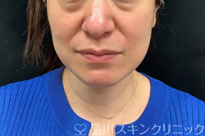 症例NO.71277のBEFORE写真