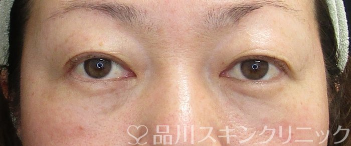 症例NO.72935のAFTER写真