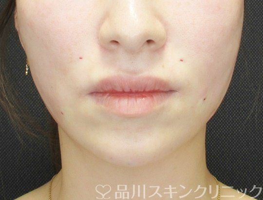 症例NO.70355のAFTER写真