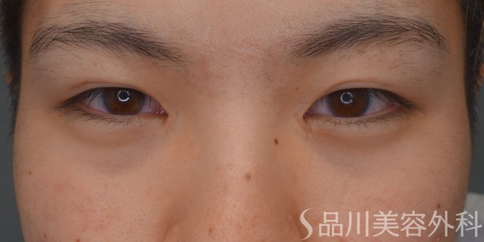 症例NO.74223のAFTER写真