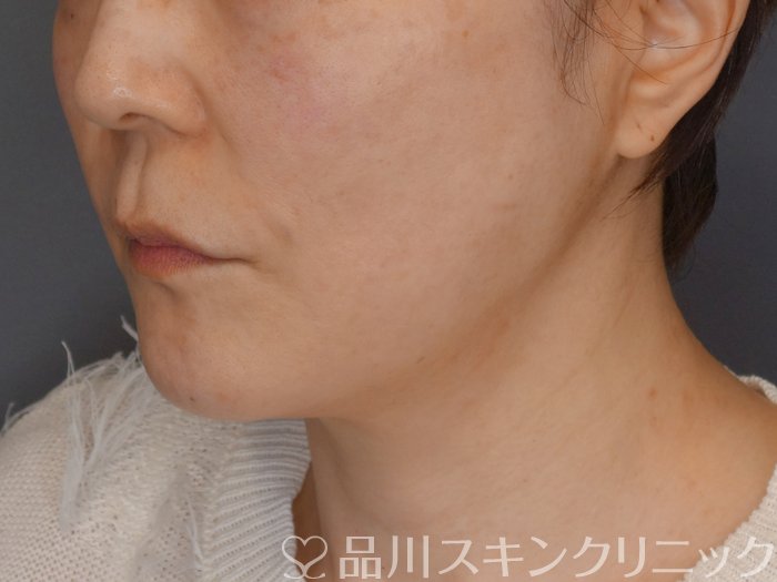 症例NO.72264のAFTER写真