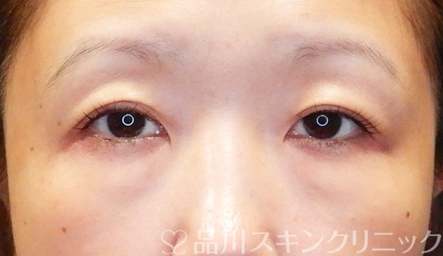 症例NO.75350のBEFORE写真