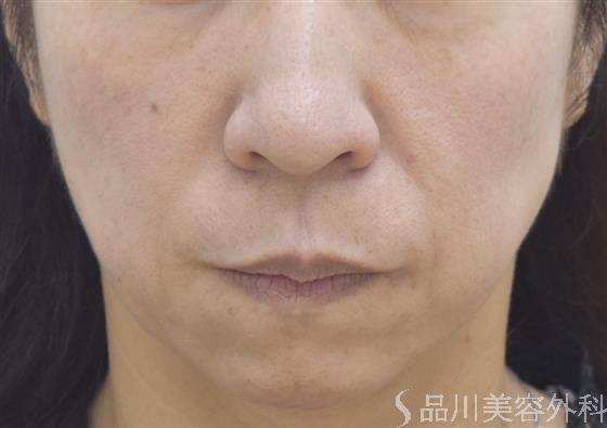 症例NO.44401のAFTER写真