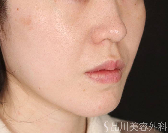 症例NO.73750のBEFORE写真