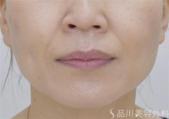 症例NO.51125のBEFORE写真