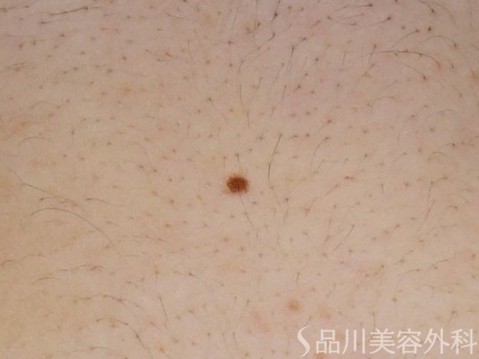 症例NO.72801のBEFORE写真