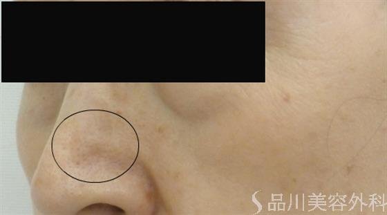 症例NO.40433のAFTER写真