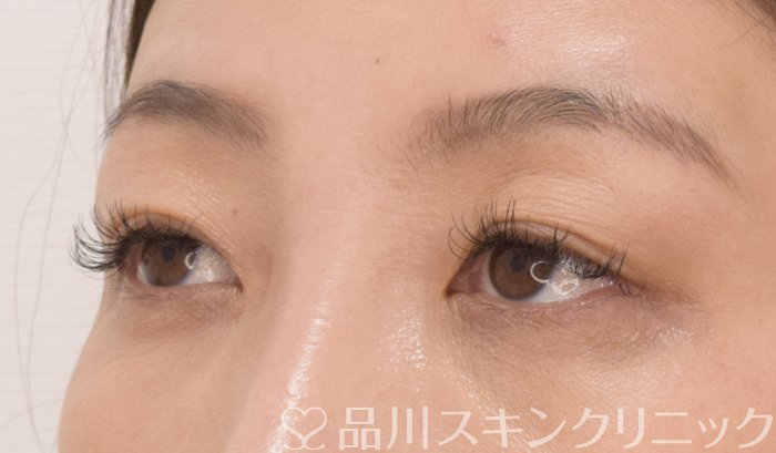 症例NO.70234のAFTER写真