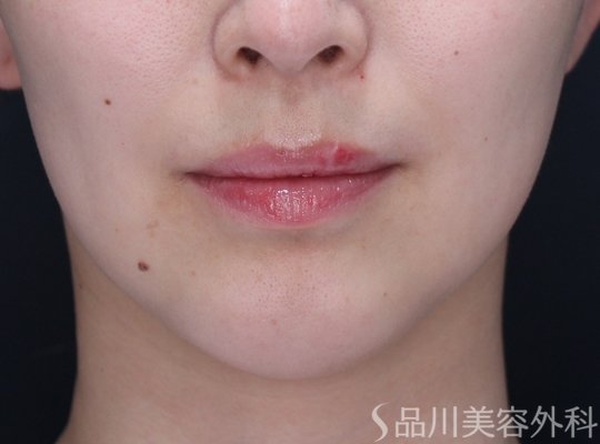 症例NO.71719のBEFORE写真