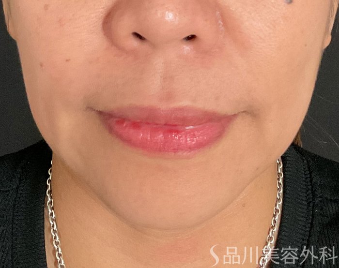 症例NO.75047のBEFORE写真