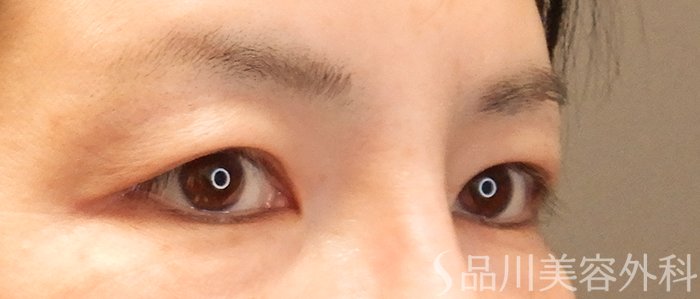 症例NO.69424のBEFORE写真