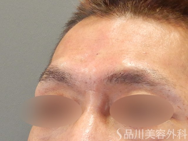 症例NO.75248のAFTER写真