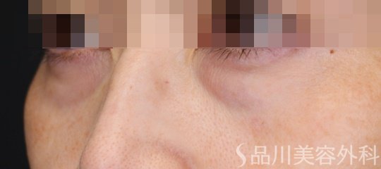 症例NO.65210のBEFORE写真