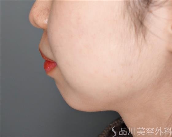 症例NO.52958のBEFORE写真