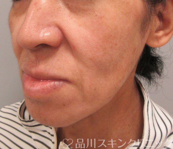 症例NO.74535のBEFORE写真