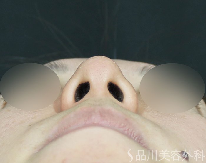 症例NO.71839のBEFORE写真