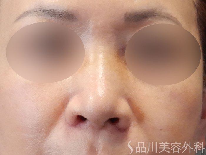 症例NO.70618のAFTER写真