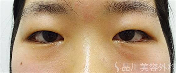 症例NO.34412のBEFORE写真