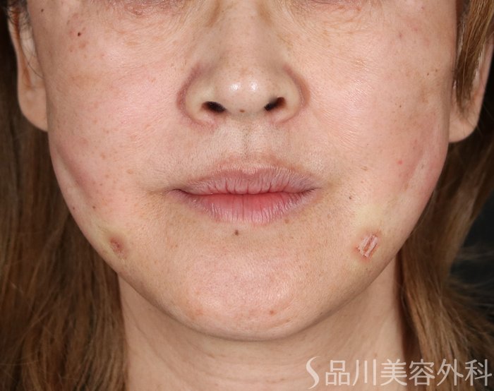 症例NO.72669のAFTER写真