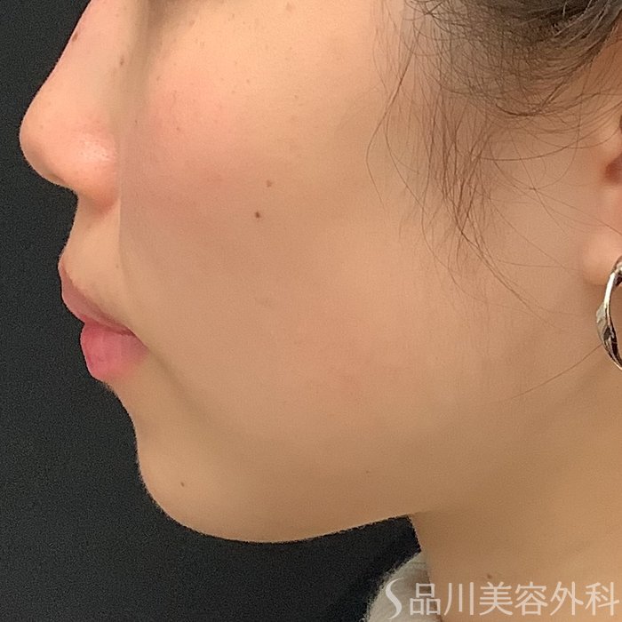 症例NO.69642のBEFORE写真