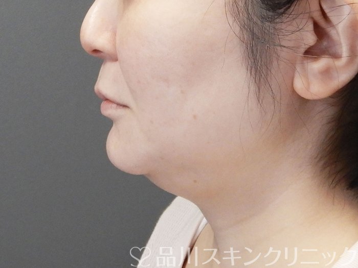 症例NO.73440のBEFORE写真