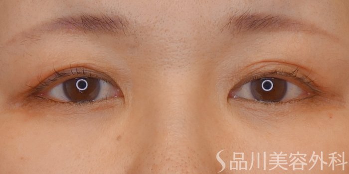 症例NO.72531のBEFORE写真