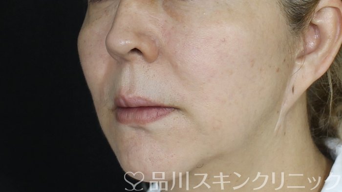 症例NO.72001のBEFORE写真