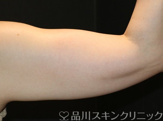 症例NO.74834のAFTER写真