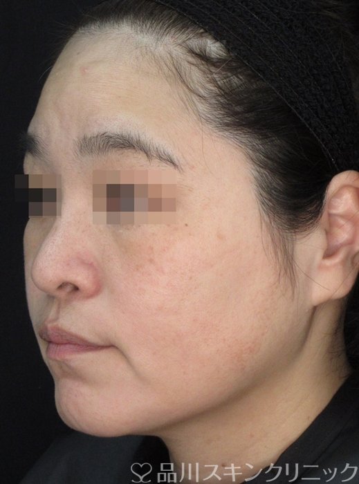 症例NO.72138のBEFORE写真