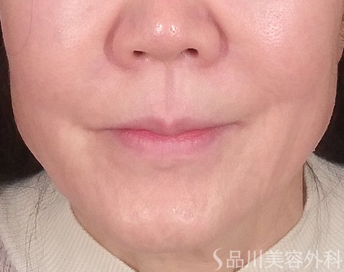 症例NO.69489のBEFORE写真