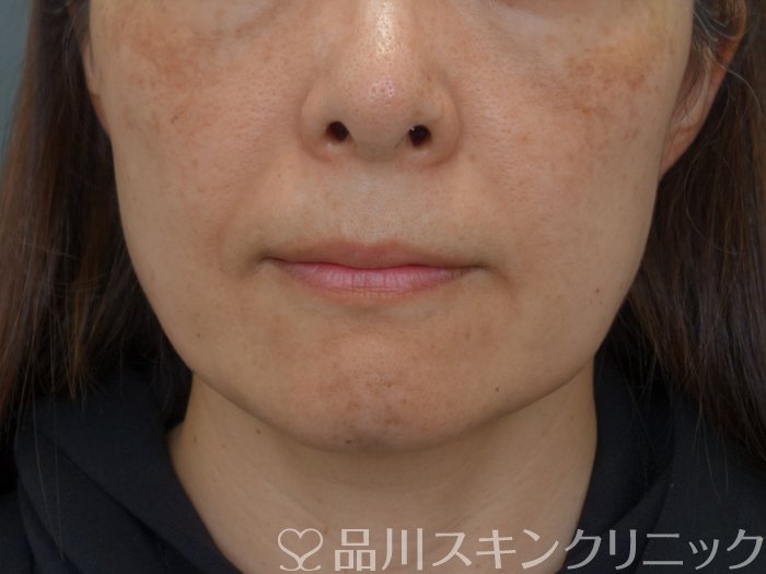 症例NO.74280のBEFORE写真