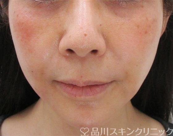 症例NO.34889のAFTER写真