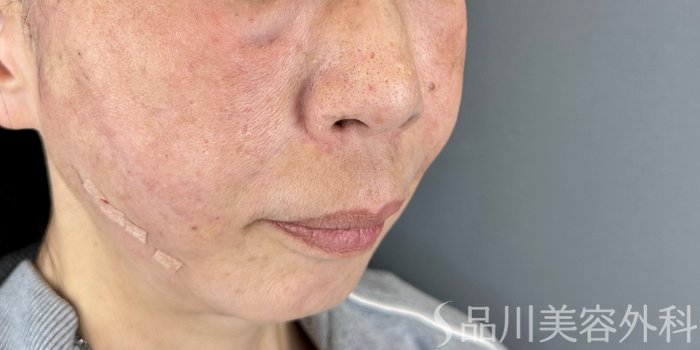 症例NO.69170のAFTER写真