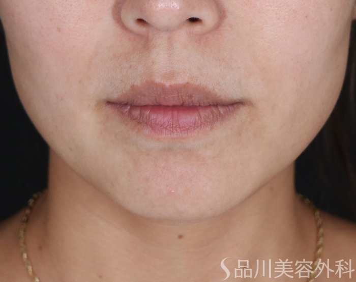 症例NO.74183のBEFORE写真