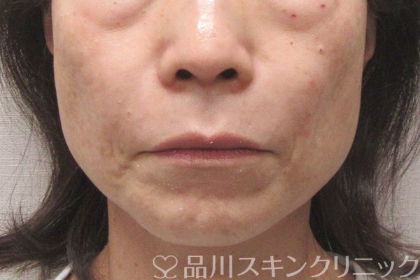 症例NO.69973のAFTER写真